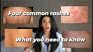 Four common rashes and everything you need to know about them!