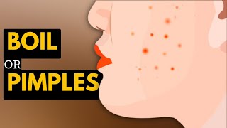 Boils vs. Pimples: What