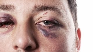 How to Treat a Black Eye | First Aid Training