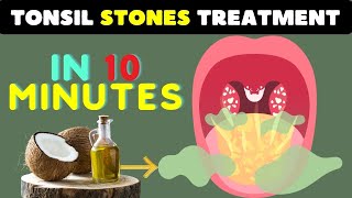How to Remove Tonsil Stones: 10 Powerful Home Remedies for Tonsil Stones Relief