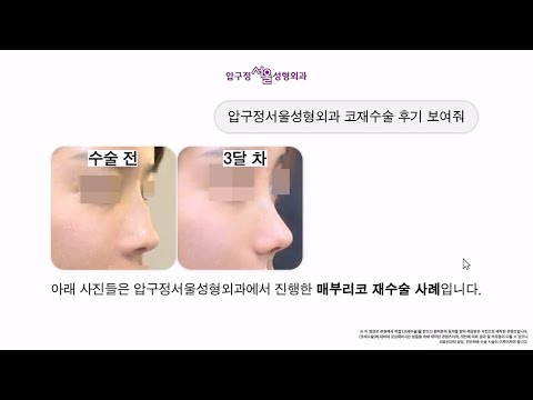 코재수술 라인정리, 코끝처짐 전후