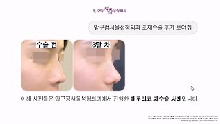  코재수술 라인정리, 코끝처짐 전후