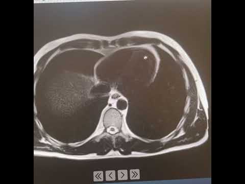 Two DANGEROUS “TOFIs” (Thin Outside Fat Inside) In One Day: Whiskey, Stress, Distance Running, Carbs