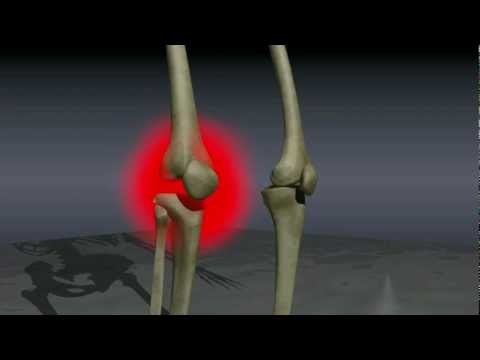 3 fokos térdízület kezelés artrózisa