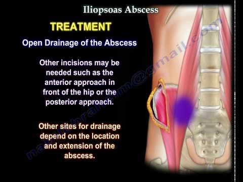Psoas Abscess - Pediatric - Pediatrics - Orthobullets