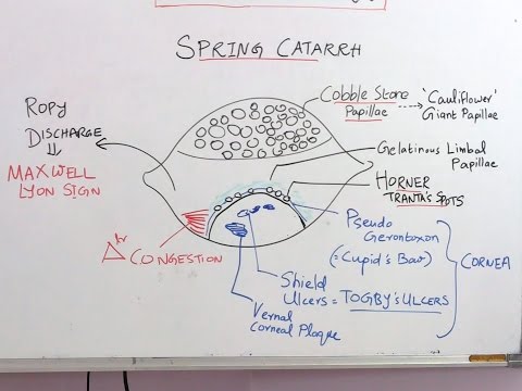 High Yield Topic: Vernal Kerato Conjunctivitis & Trachoma