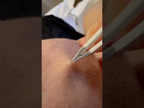 Satisfying Routine: Beard Removal with Tweezers #hairremoval #beardplucking #tweezers