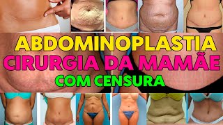 ABDOMINOPLASTIA ANTES E DEPOIS - COM CENSURA