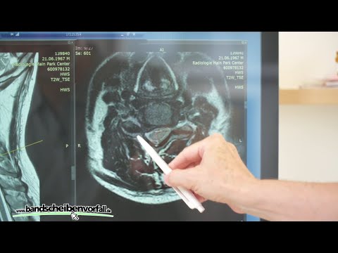 Welche Operation bei Bandscheibenvorfall HWS gibt es ?