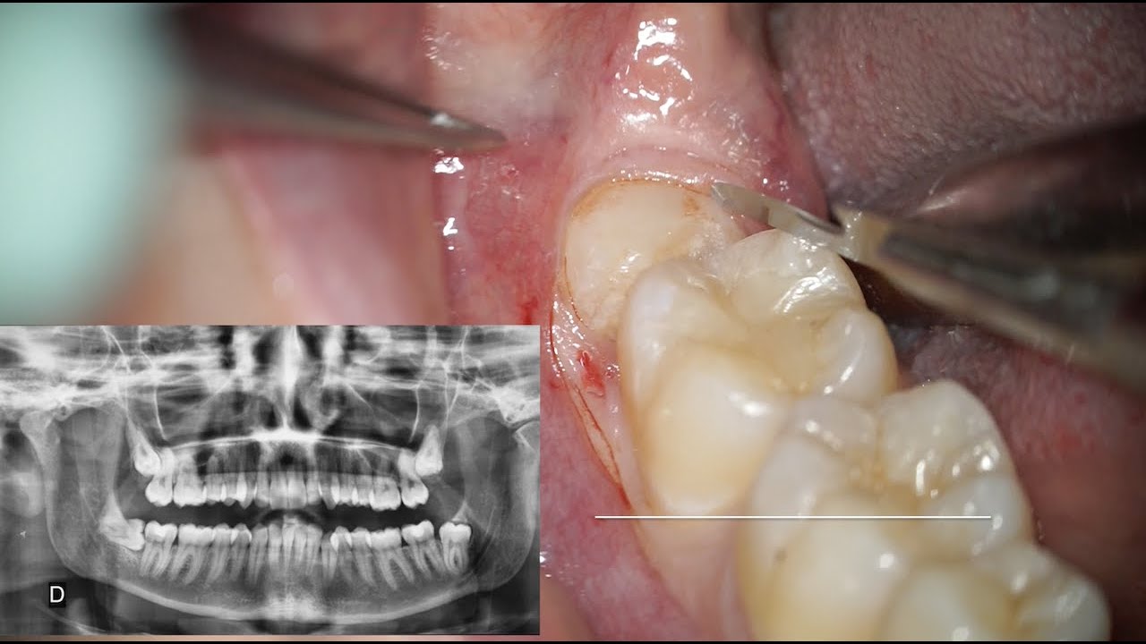 Watch Now Estrazione dente del giudizio incluso con chirurgia sonica - Dr. Fabio Cozzolino Estrazione dente del giudizio incluso con chirurgia sonica - Dr. Fabio Cozzolino
