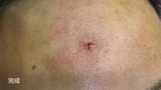 [問題] 有人在中壢的醫院或診所割過脂肪瘤嗎?