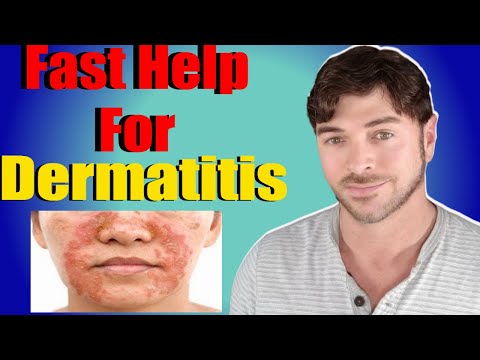 Fast Help For Seborrheic Dermatitis | Face and Scalp | Chris Gibson