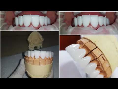 Diseño de Sonrisa. Estetica dental(3)