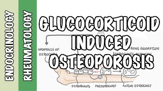 Glucocorticoid Induced Osteoporosis and Fractures - mechanism and pathophysiology of fractures
