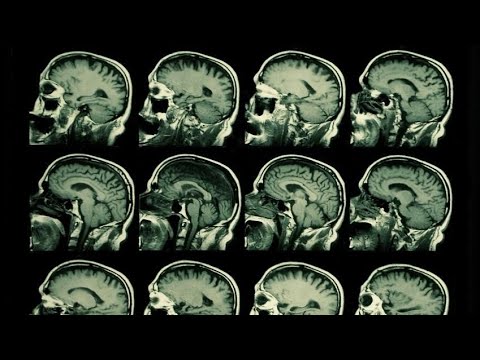 BU researchers find CTE in brains of dozens of young athletes