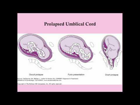 Obstetric Complications of Labor - CRASH! Medical Review Series