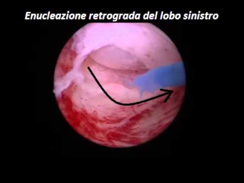 Si può riscaldare con prostatite Farmaci da nome prostatite