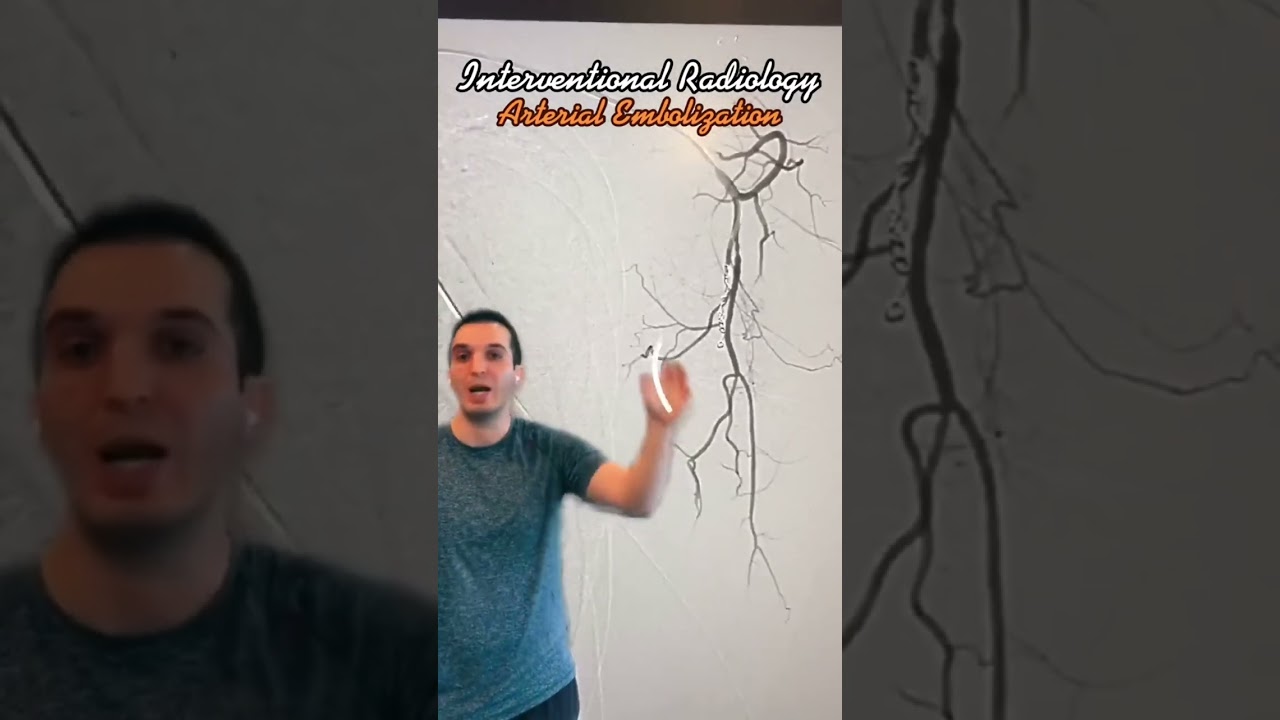 How radiology treats a bleeding stab victim 🩸
