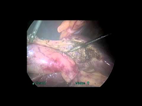 Lewostronny pęcherzyk żółciowy-cholecystektomia laparoskopowa