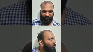 Download lagu {2024 } {Grade 6 }🔥Hair Transplant Results #shorts #medlinks mp3