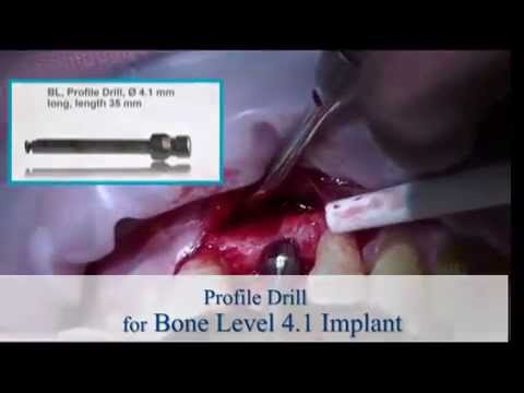 Anterior Single Implant Placement with Guided Bone Regeneration