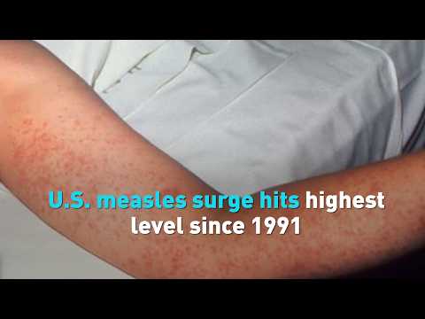 U.S. measles surge hits highest level since 1991