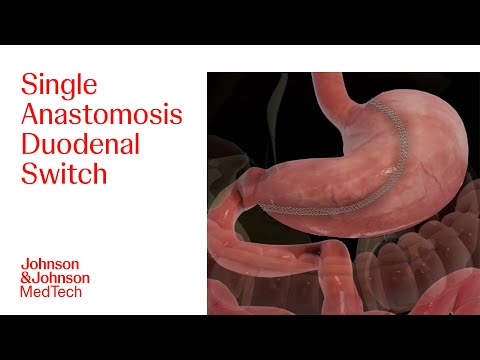 Loop Duodenal Switch Procedure Animation | J&J MedTech