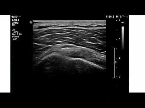 Unguente de încălzire pentru osteochondroza lombară