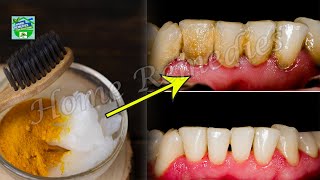How To Remove Plaque And Tartar From Your Teeth Without A Dentist