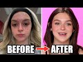 My Acne Skin Care Routine How To Tips