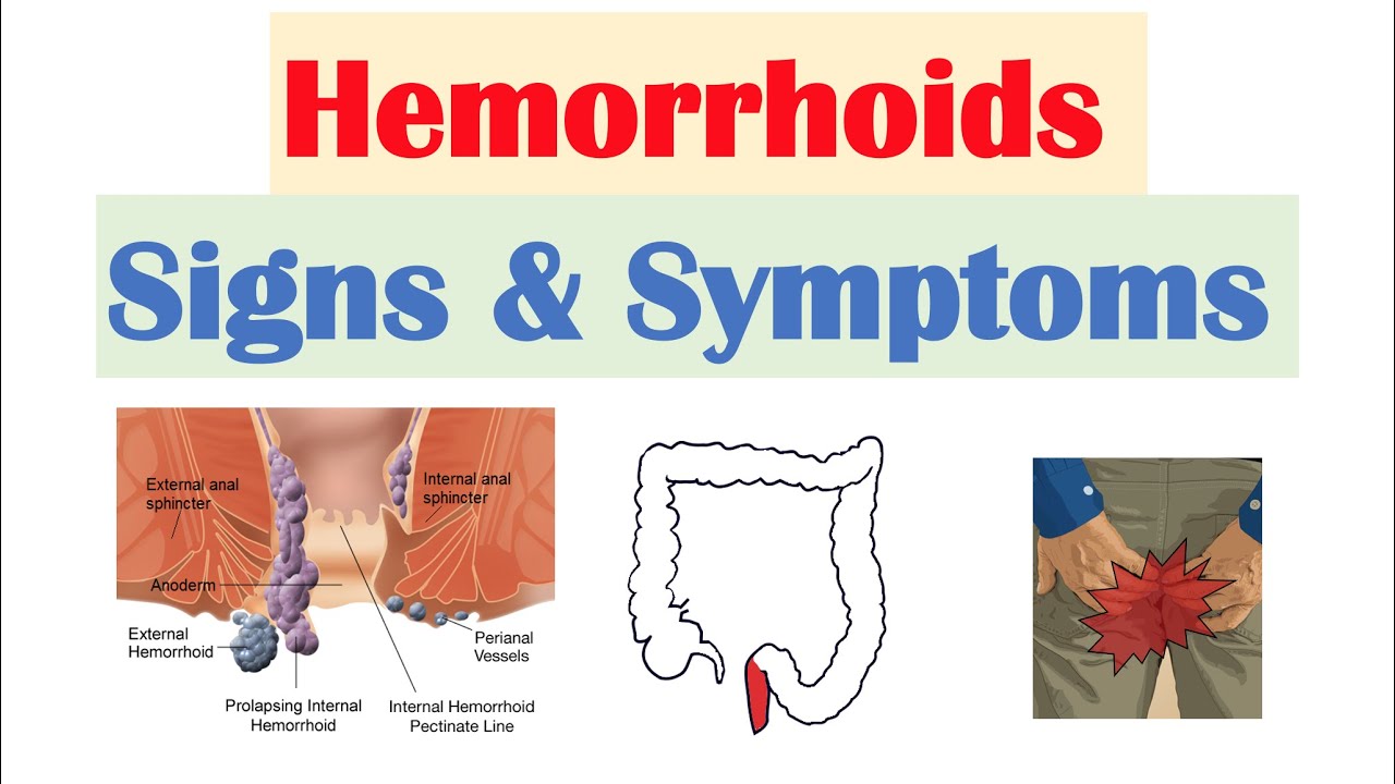 Hemorrhoids Signs & Symptoms | Internal vs. External Hemorrhoid Symptoms | Hemorrhoidal Disease