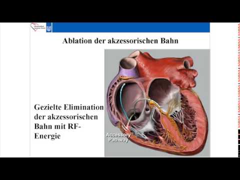 Hypertensive vaskuläre Erkrankung Myokardiale Remodeling bei Patienten mit arterieller Hypertonie