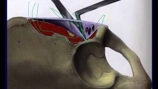 Acetabulum fracture surgical approaches - Ilioinguinal (OTA lecture series III v05b)