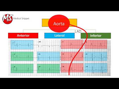 ECG localisation of the occluded coronary artery (Myocardial Infarction)