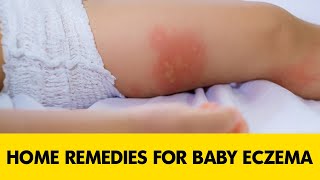 ✅ Home remedies for baby eczema on face || how to get rid of baby eczema fast