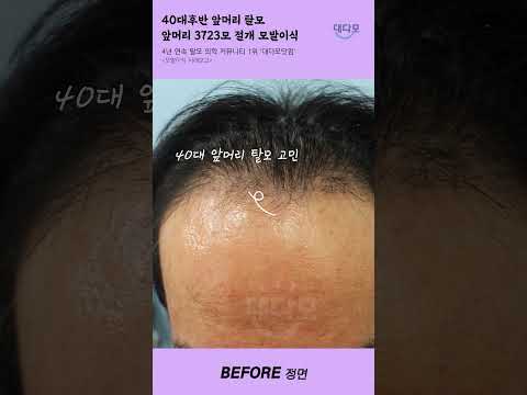 40岁后半段的男士刘海脱发, 切开毛发移植 3723毛 Before & After [#shorts]