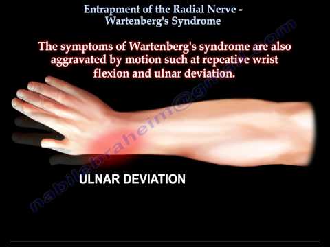 Entrapment of Radial Nerve, Wartenberg's Syndrome - Everything You Need To Know - Dr. Nabil Ebraheim
