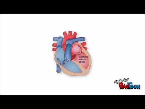 Síndrome Turner Escolar