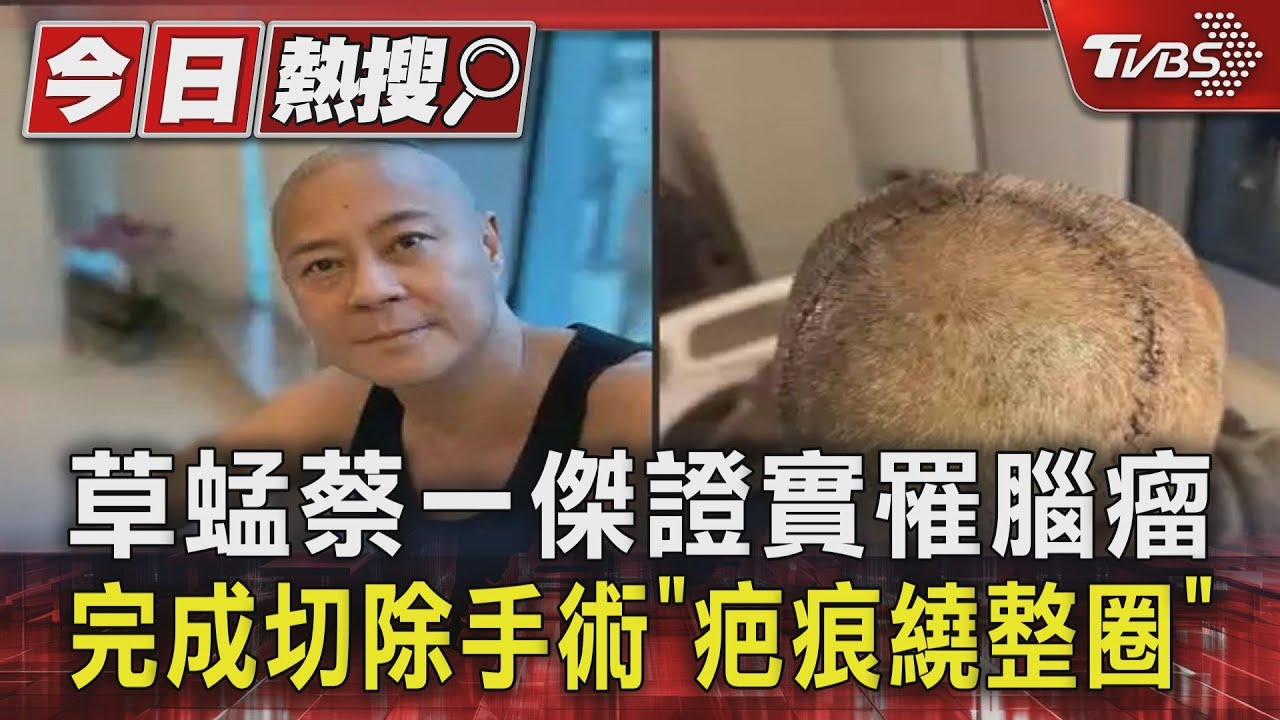 草蜢蔡一傑證實罹腦瘤 完成切除手術「疤痕繞整圈」