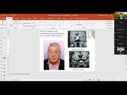 Pitutary Apoplexy –  Professor Tomislav Sajkp