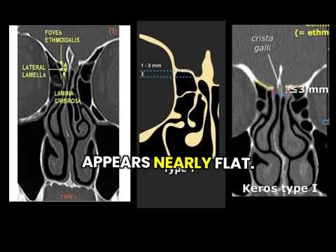 Keros Classification | Skull Base Risk in Endoscopic Sinus Surgery @ENTforall-k6l 