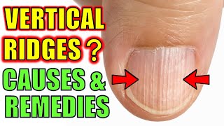Do You Have Vertical Ridges On Your Nails - Causes & Natural Cures