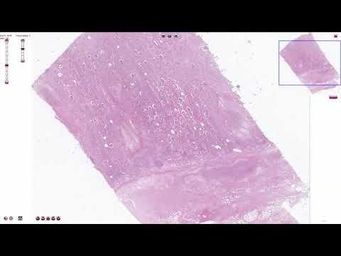 Acute Pyelonephritis - Histopathology