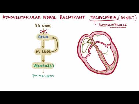 Atrioventricular reentrant tachycardia AVRT & nodal reentrant tachycardia AVNRT