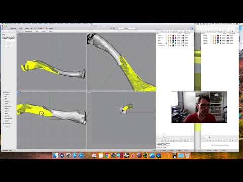 3D Planning a Clavicle Non-Union - real-time video