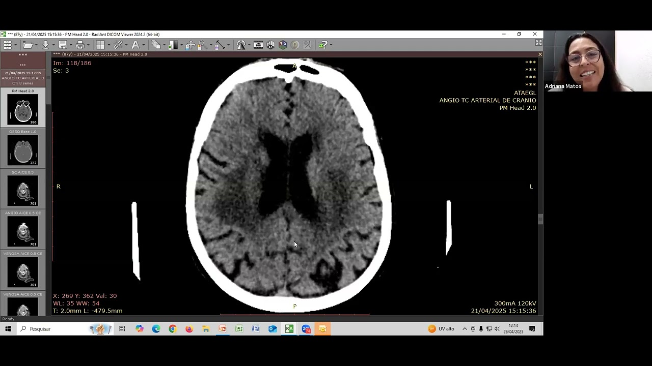 Discussão de Caso Real de AngioTC no Protocolo do AVC