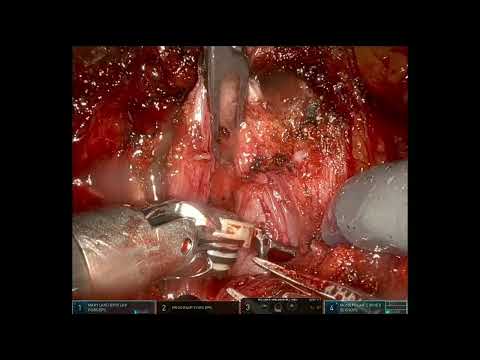 Robotic transplant