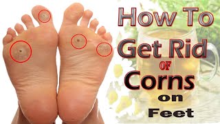 How to Get Rid of Corns on Feet Naturally at Home || Home Remedies for Corns on Feet