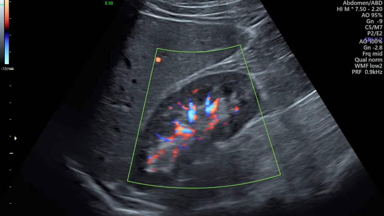 AVALIAÇÃO DE CIRCULAÇÃO RENAL  DOPPLER DAS ARTÉRIA RENAIS