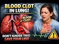Pulmonary Embolism Spot These Symptoms Before It S Too Late